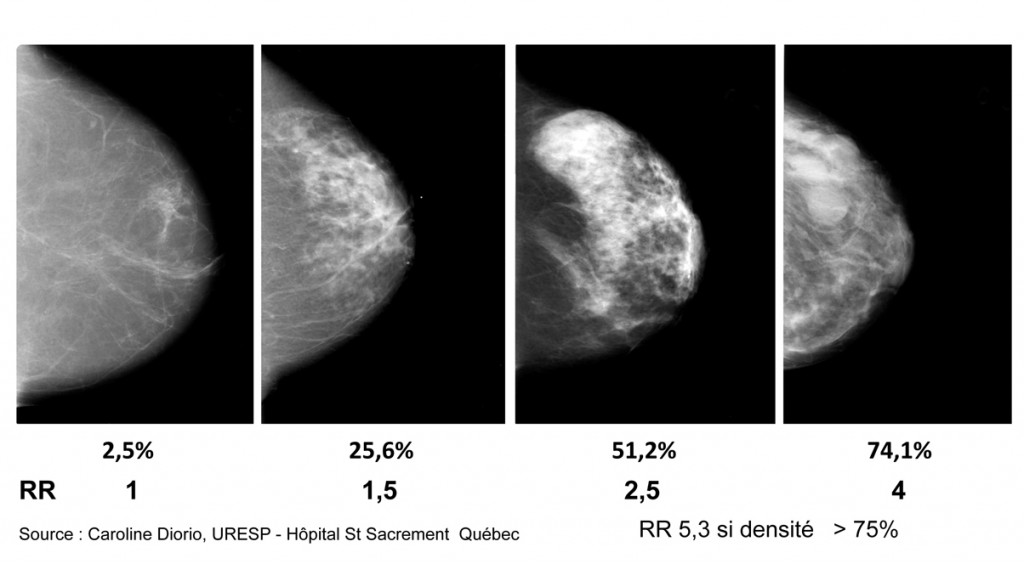 DensitÄ mammaire_1