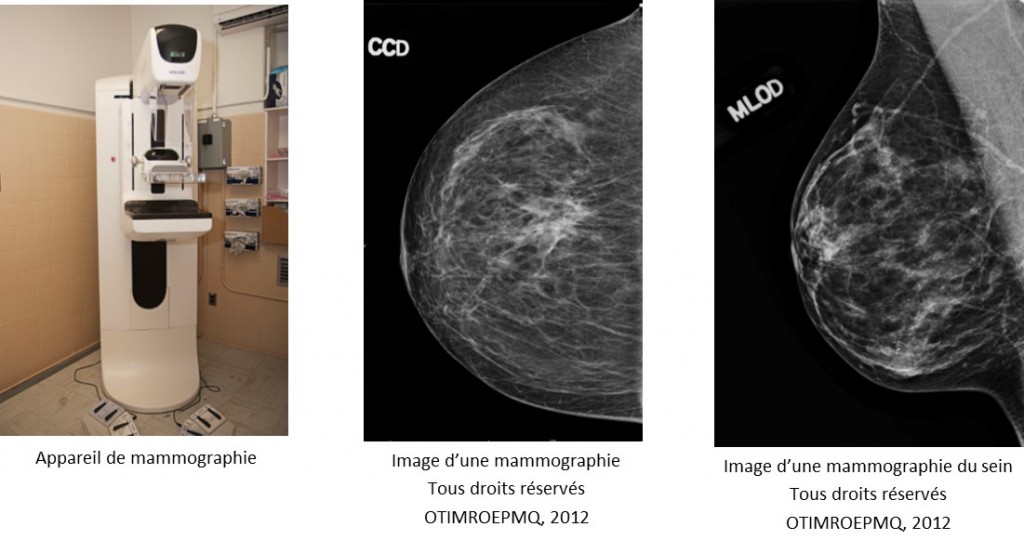 mammographie de depistage