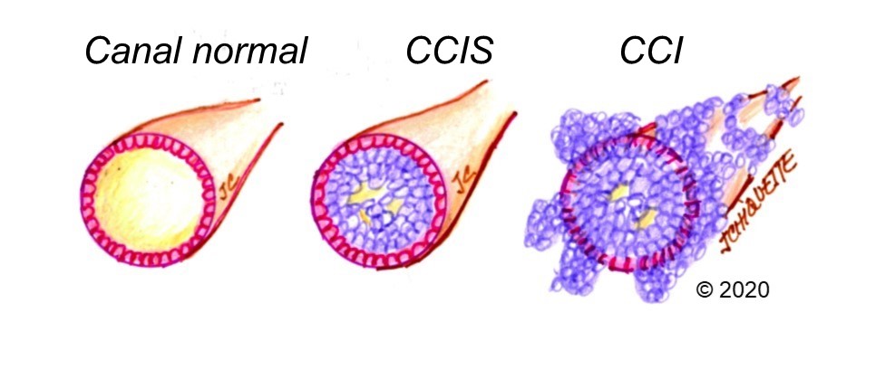 Types de cancer du sein -