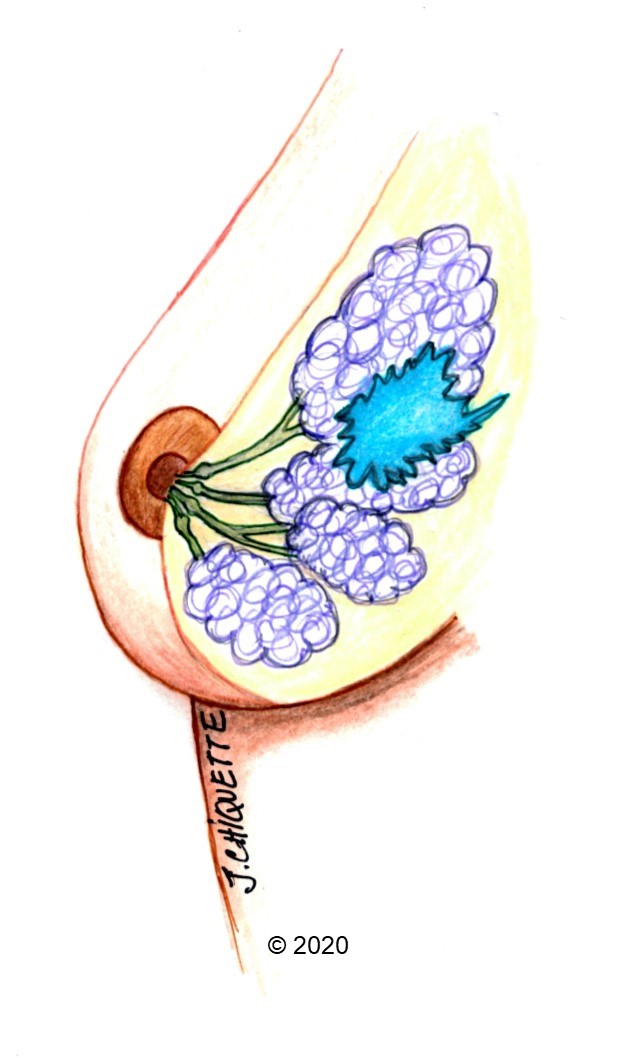 Cancer hormonal infiltrant. Cancerul de San(2019)