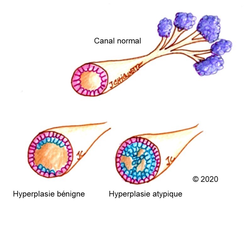 Hyperplasie canalaire atypique