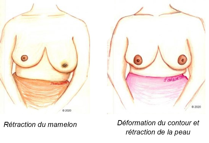 Cancerul la sân (cancerul mamar): tipuri, factori de risc, simptome, diagnostic, tratament