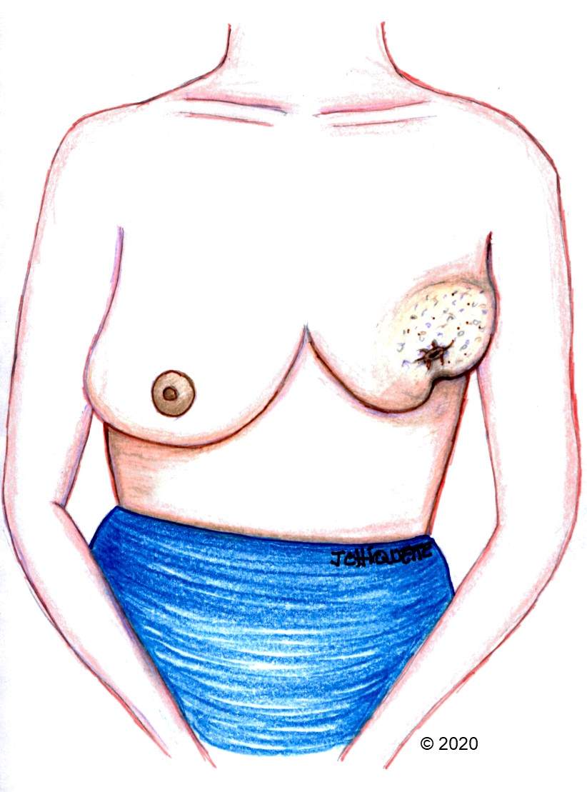 Care sunt simptomele de depistare ale cancerului mamar? - Cancer ulcere mamelon