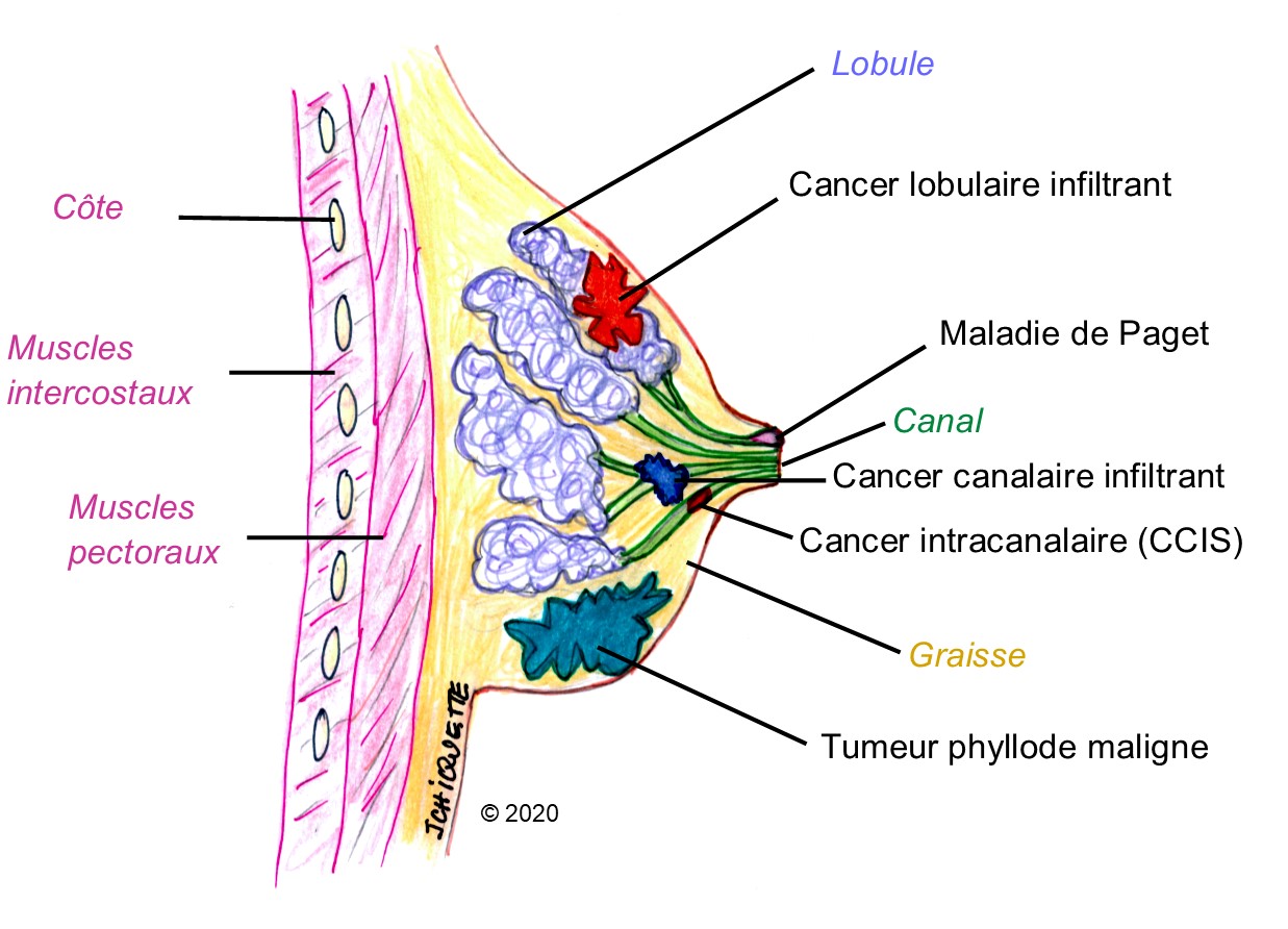 Carcinome infiltrant