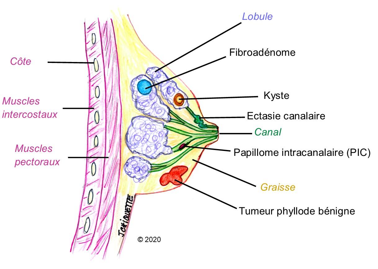 Nodule bénin